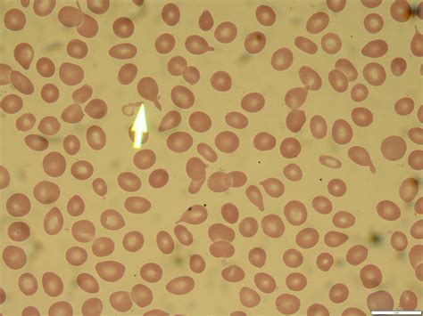 What is the significance of teardrop cells (dacrocytes) 